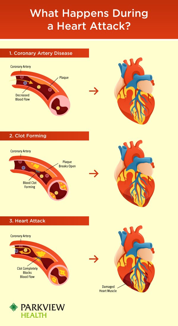 Ms Heart Attack